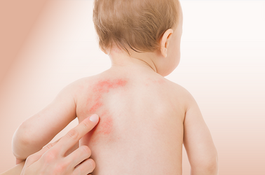 Dlaczego zimą skóra dzieci choruje częściej? Jak pediatra może szybko postawić diagnozę i wdrożyć skuteczne leczenie